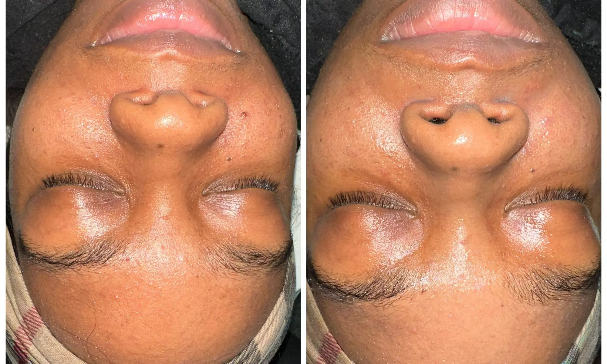 Up to 47% Off on Chemical Peel at Honey B Esthetics - Second Medium