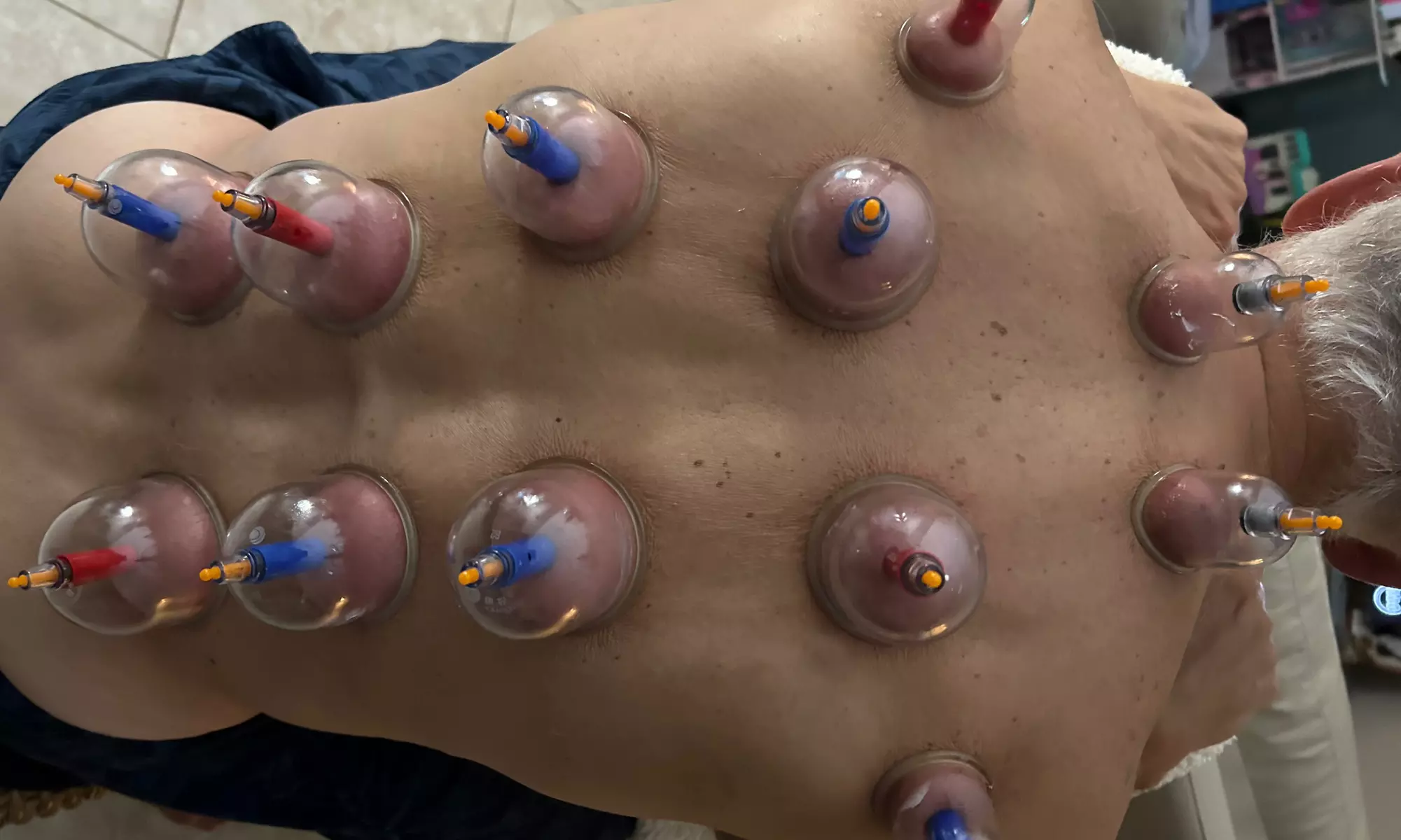 Revitalize with Cupping, Acupuncture, or Gua Sha Sessions