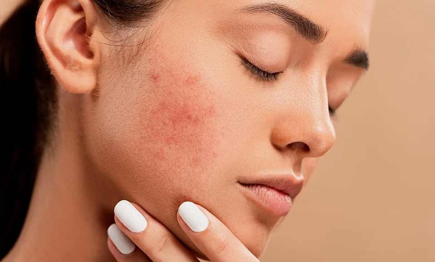 Image 3: Up to 55% Off on Acne Treatment (Service) at UK Aesthetics Lounge