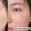 Image 1: 1 or 3 IPL Acne, Melasma, Brown Spots, or Rejuvenation Treatments
