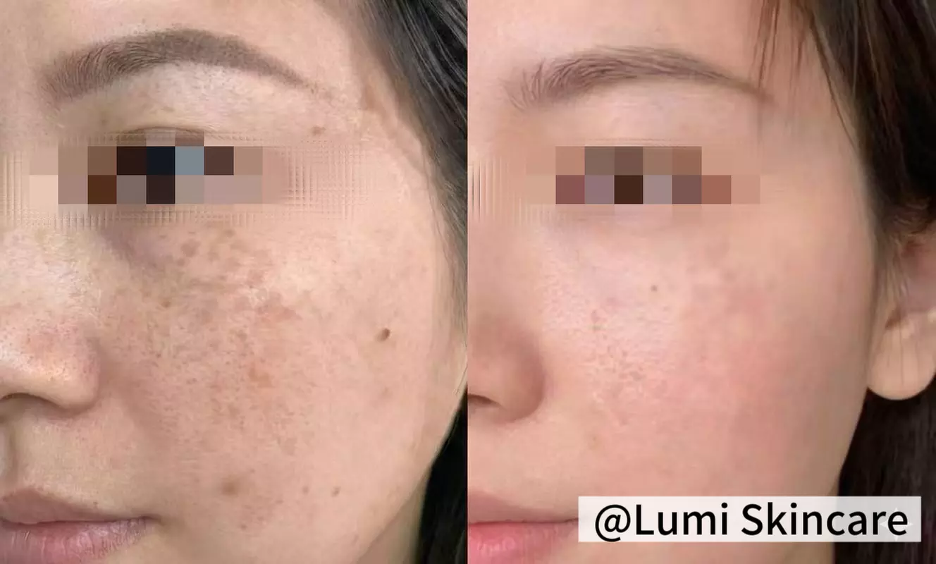 1 or 3 IPL Acne, Melasma, Brown Spots, or Rejuvenation Treatments