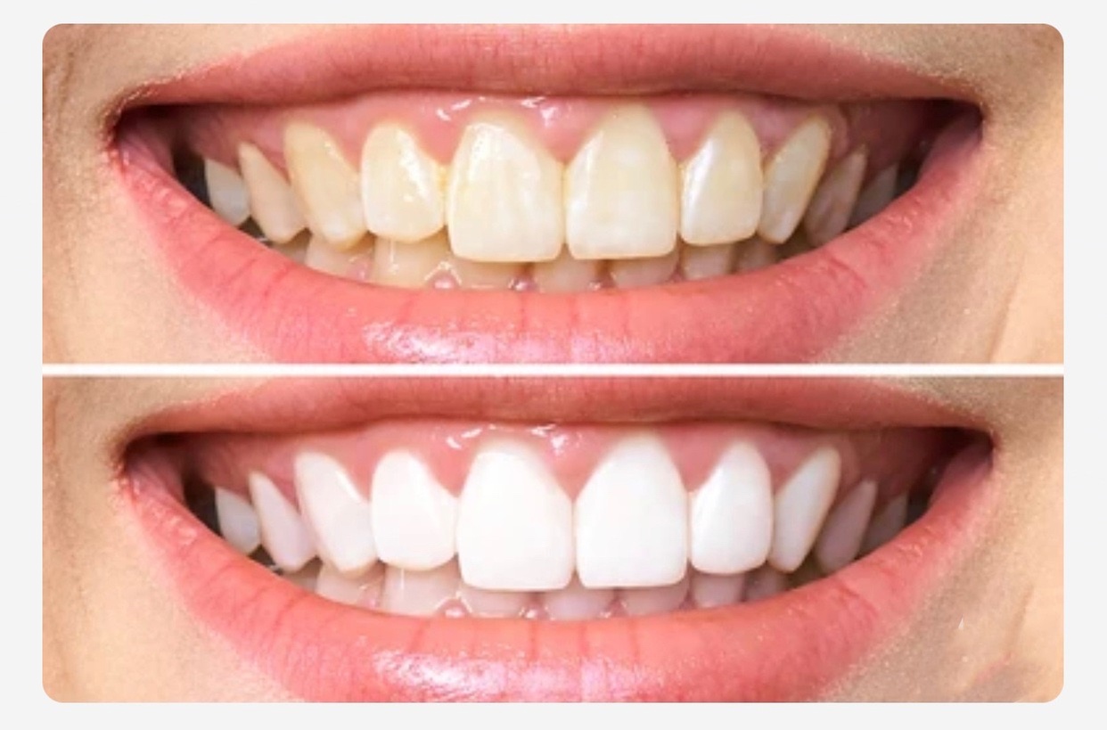 Brighten Your Smile with Two Teeth Whitening Sessions