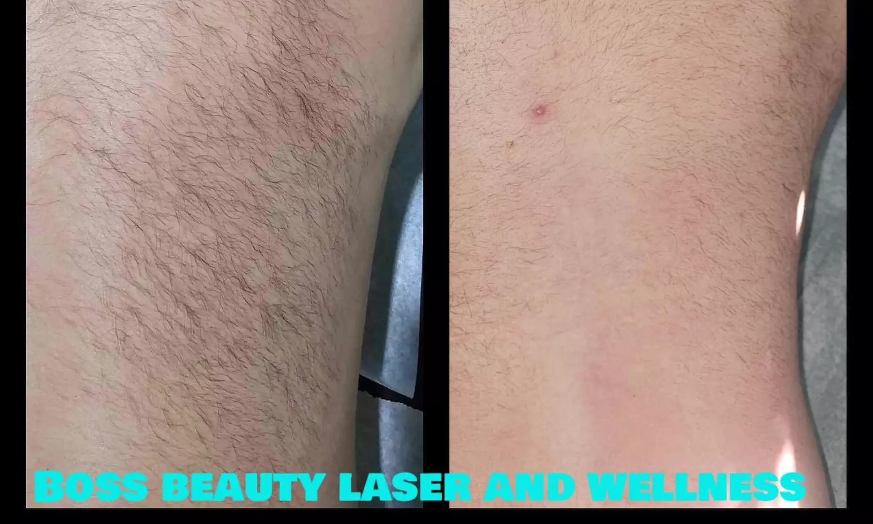 Full Body IPL Hair Removal at Boss Beauty Laser and Wellness Clinic