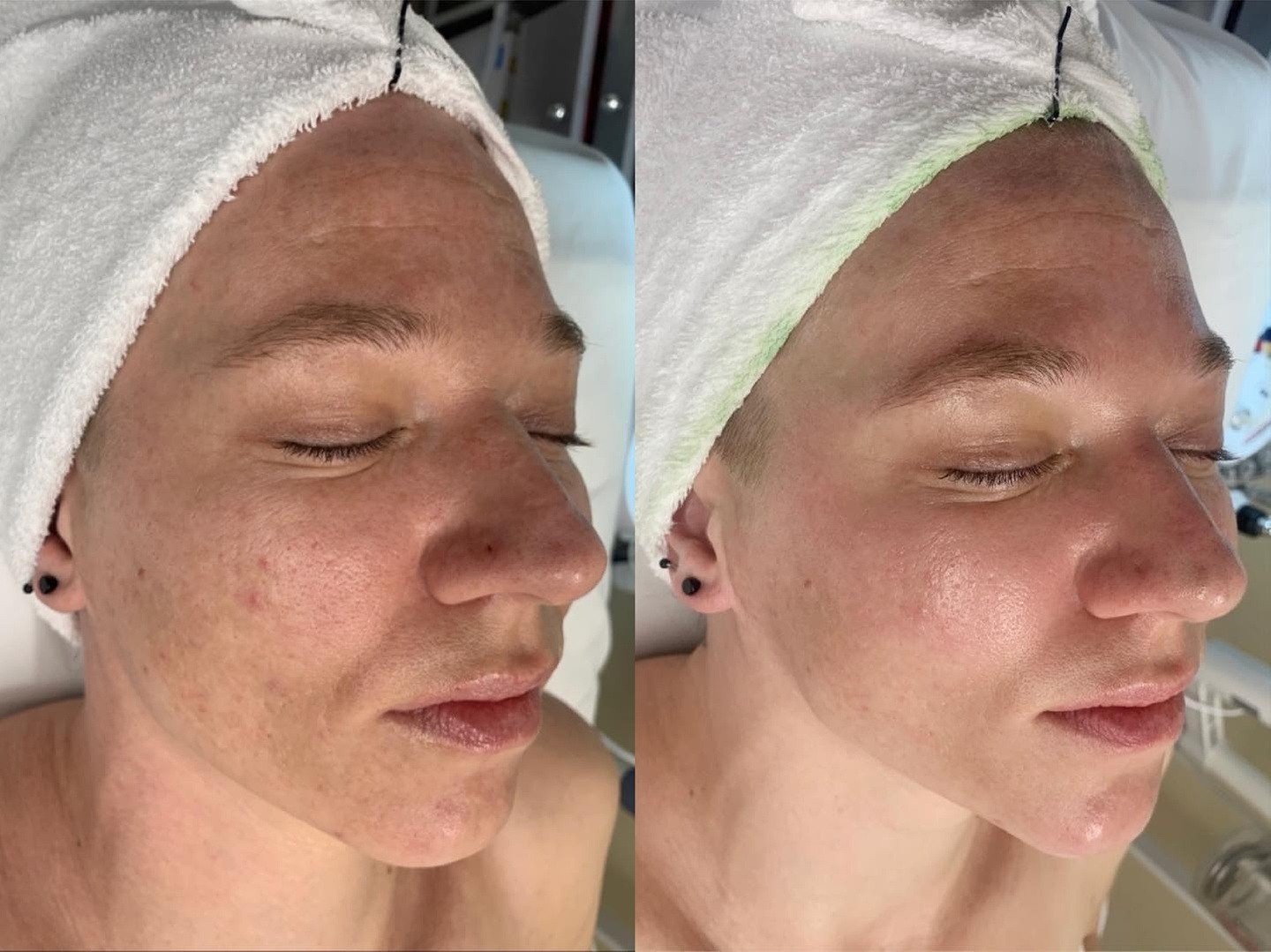 Up to 56% Off on HydraFacial at LUXPAR BEAUTY