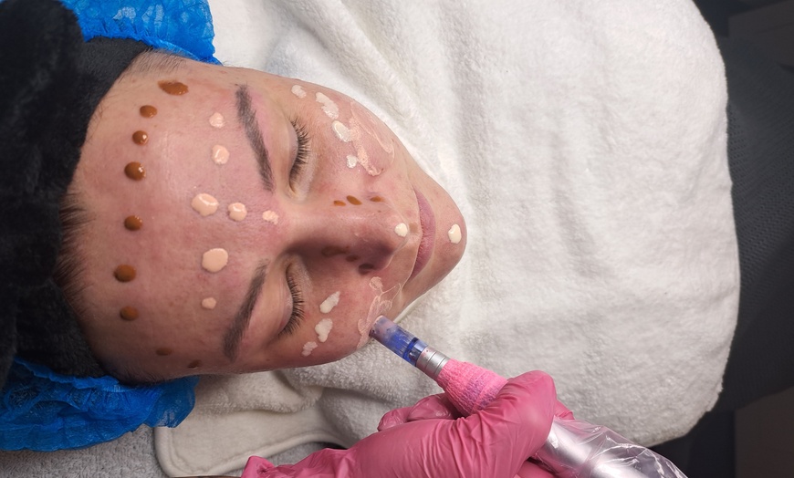 Image 2: Kombi-Gesichtsbehandlung mit Microneedling & BB Glow für 1 Person