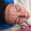 Image 2: Kombi-Gesichtsbehandlung mit Microneedling & BB Glow für 1 Person