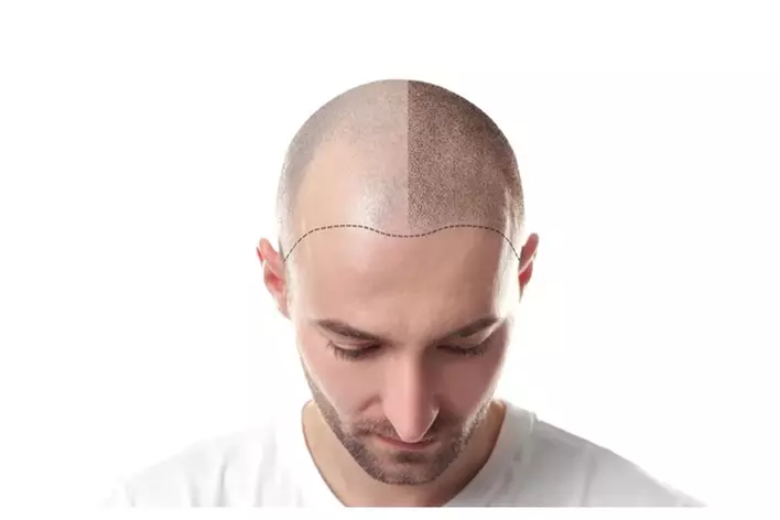 Achieve Fuller Hair with Scalp Micro Pigmentation Options