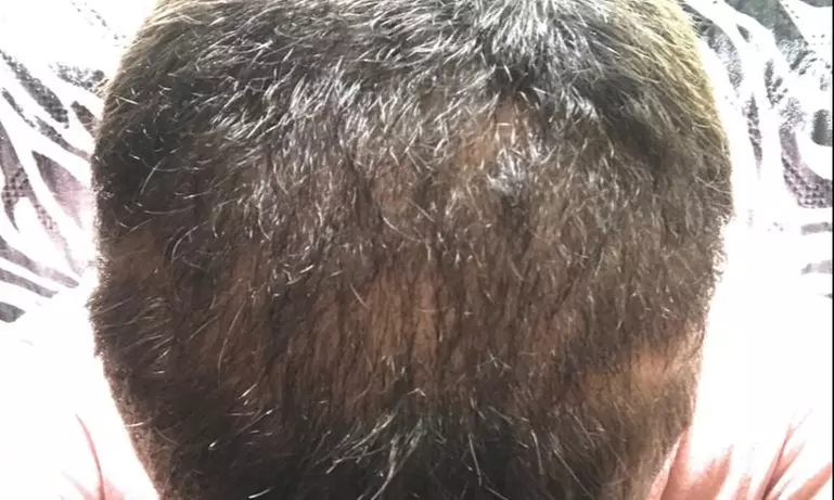 Up to 56% Off on Hair Restoration - Non-Surgical at House of Sifnod Trichology - Second Medium