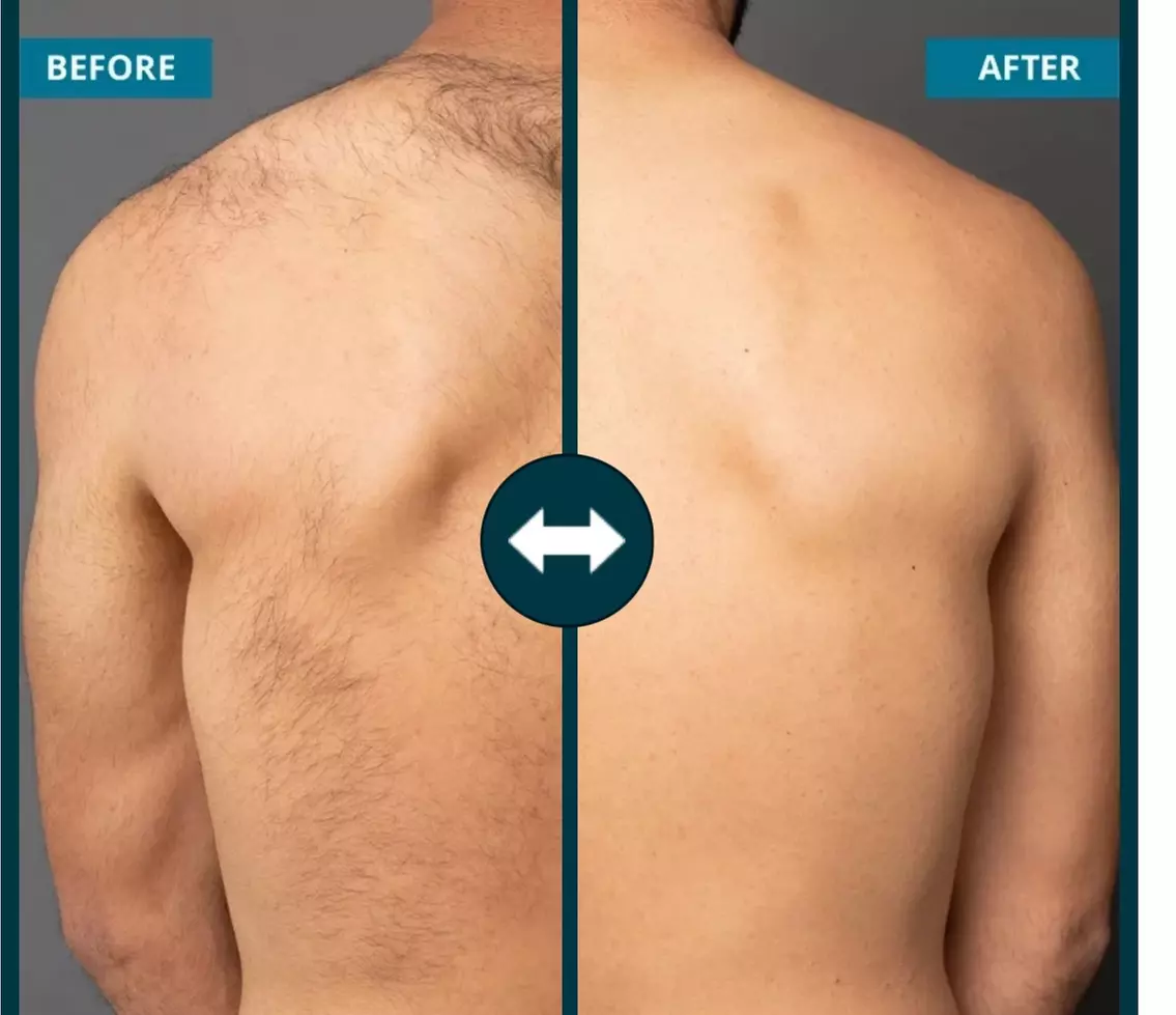 Up to 69% Off on Soprano Laser Hair Removal at Aesthetics Care Med Spa