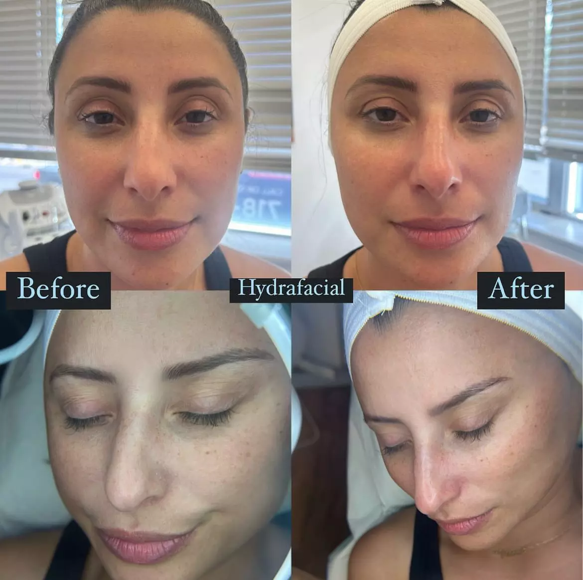 Up to 60% Off on Anti-Aging Facial at SAAESTHETICS - Second Medium