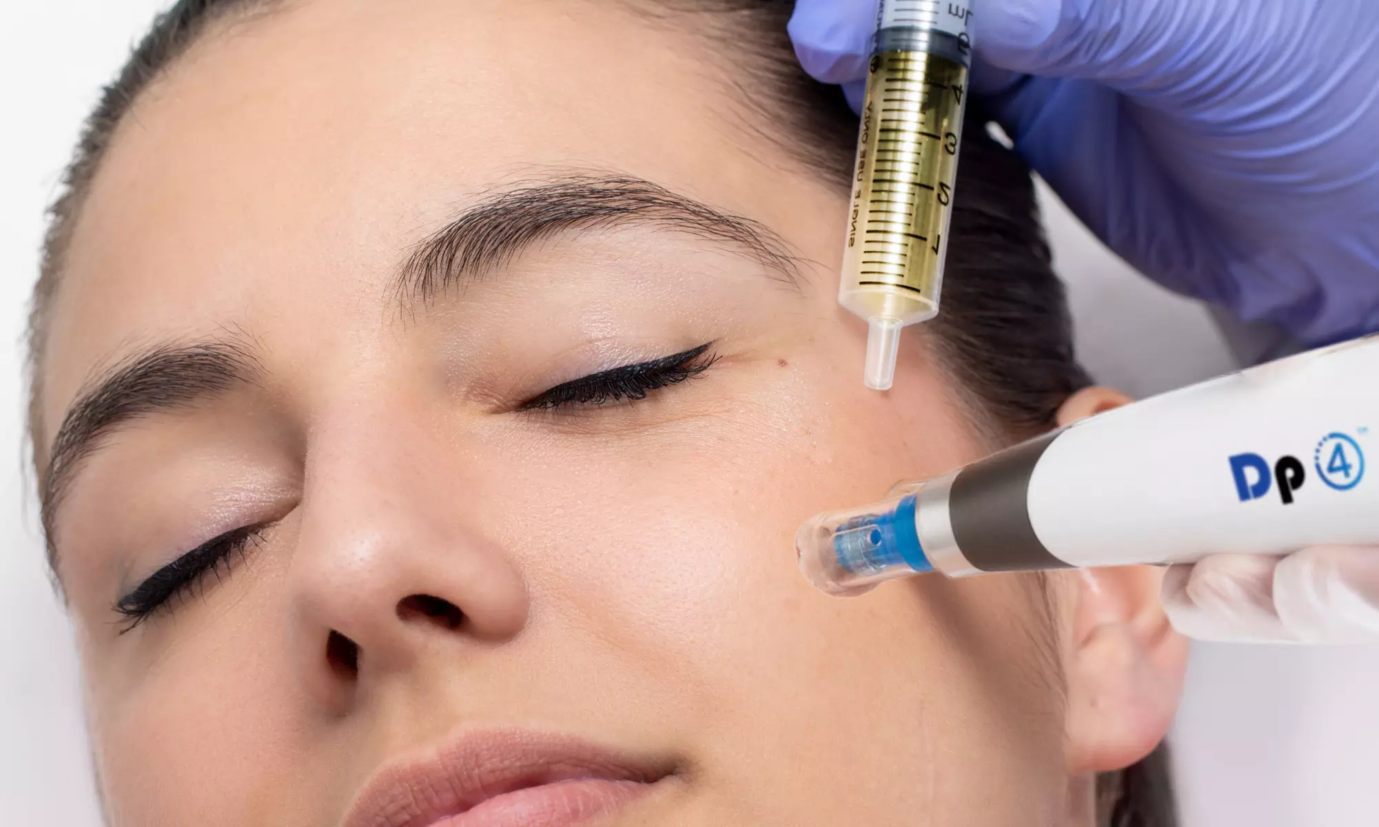 Up to 50% Off on Microneedling Treatment at New Skin by Lynn - Primary Image