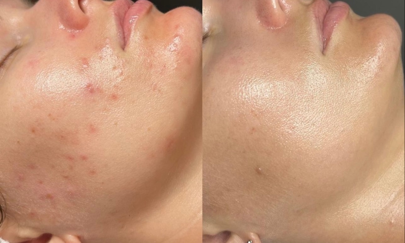 Up to 66% Off on Micro-Needling at Aesthetics By Shanty