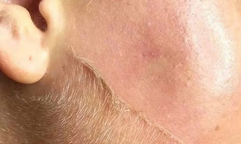 60-Min Dermaplanning w/ Chemical Peel & Optional LED Light Therapy