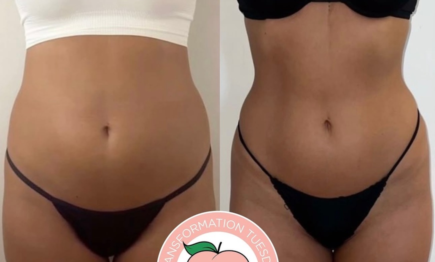Image 1: Up to 50% Off on Liposuction - Non-Invasive Laser (iLipo) at Body Contour of Essex