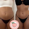 Image 1: Up to 50% Off on Liposuction - Laser at Body Contour of Essex