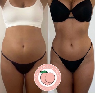 Detox Tummy Slimming Wrap - Body Contour of Essex