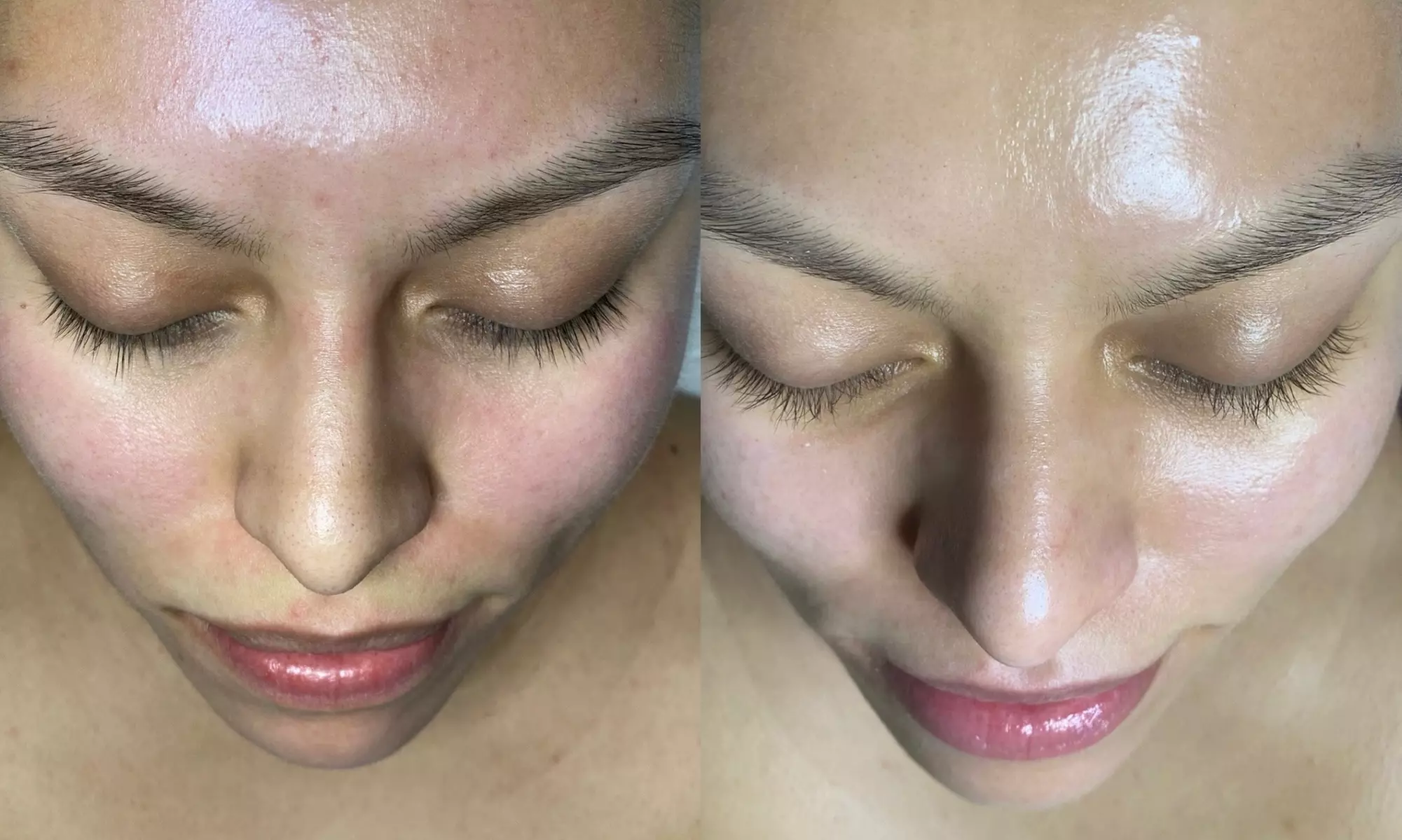 Up to 40% Off on Facial at Skin by Emely