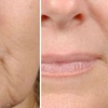 Image 1: Try One or Three Radio Frequency Skin Tightening Treatments Today