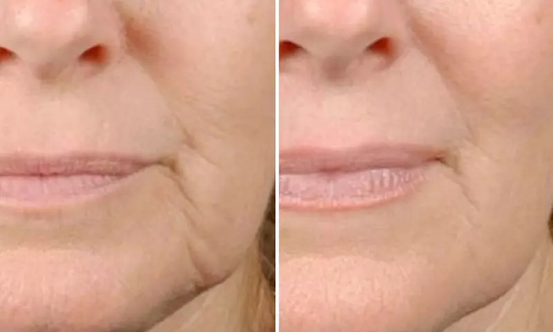 Try One or Three Radio Frequency Skin Tightening Treatments Today