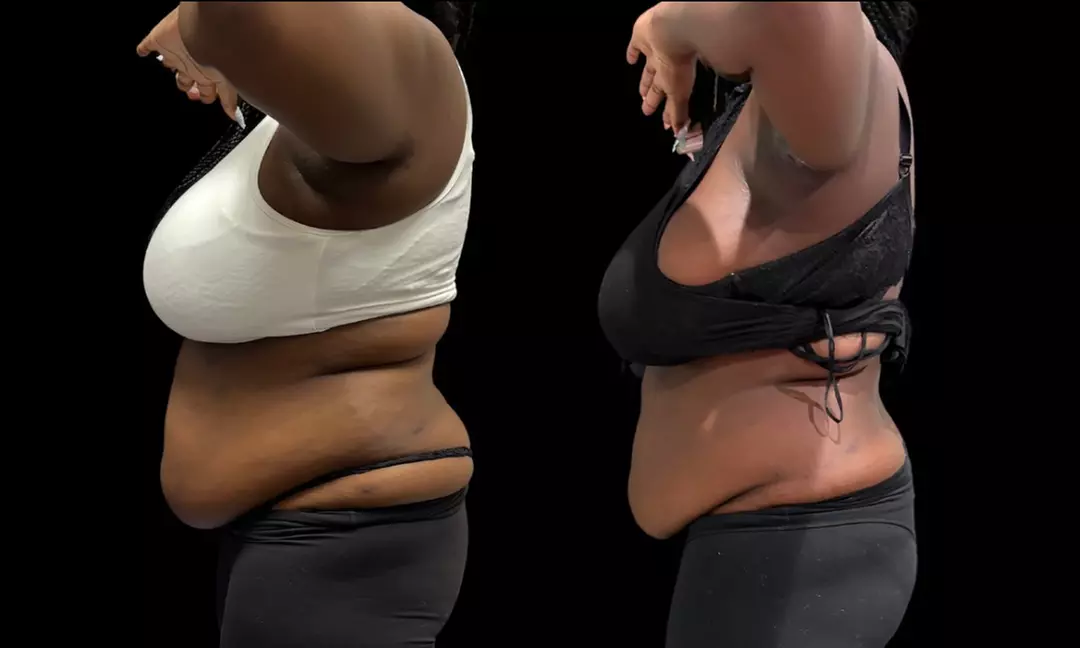 Up to 53% Off on Fat Reduction - Non-Branded at Southern Shapez