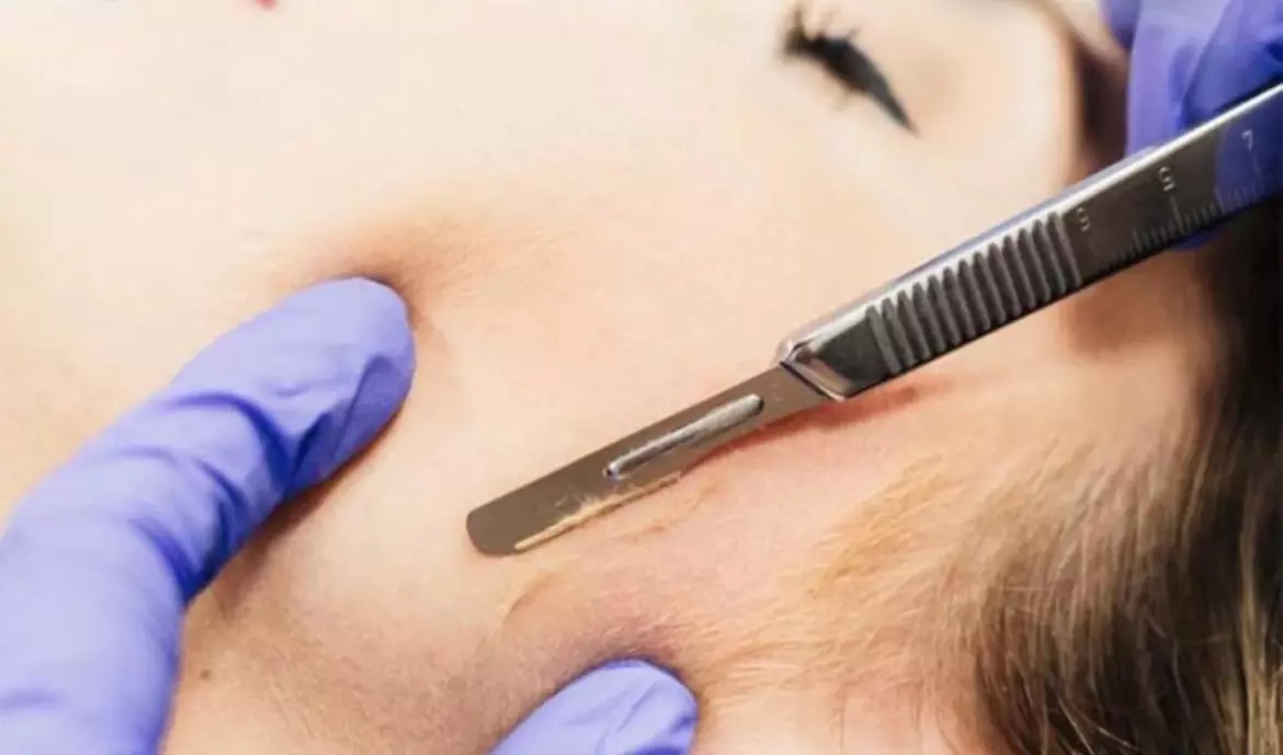 Bloom Beauty offers 60-minute exfoliating dermaplaning facials in single or triple sessions, with up to 35% off - Primary Image