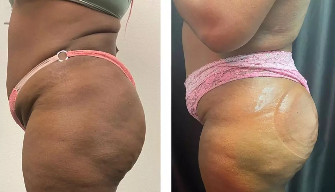 Discover Lash gem's tailored non-surgical butt lift options with up to 50% off for enhancing your curves - Second Medium