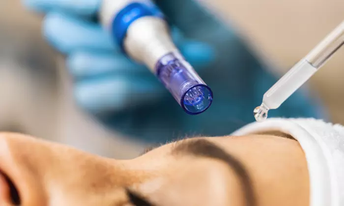 Experience Microneedling Magic for Smooth Skin