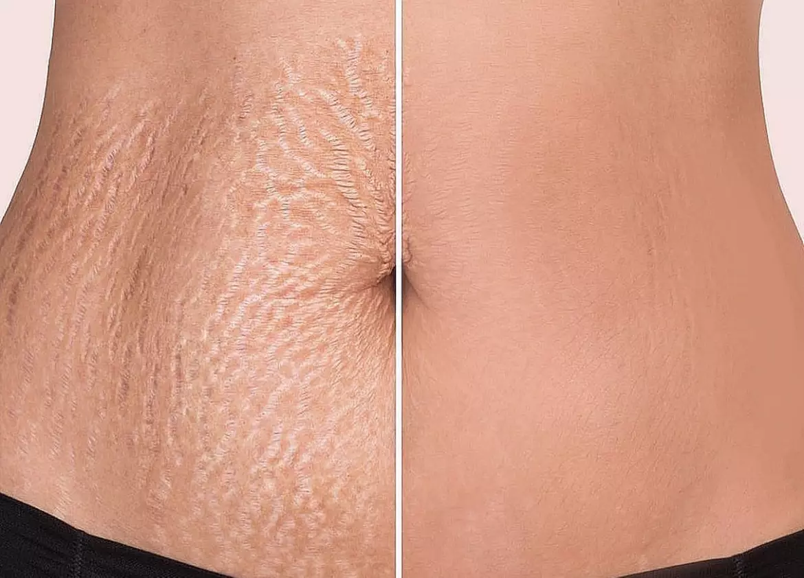 Up to 38% Off on Stretch Mark and Scar Camouflage at Blink Pretty Aesthetics - Primary Image