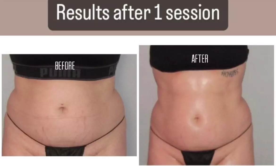 Up to 30% Off on Cavitation at Beauty, Body & Mind Co - Primary Image