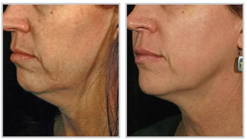 Up to 60% Off on Cavitation at Your sculpture - Primary Image