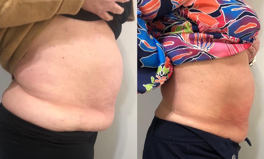 Image 3: Up to 60% Off on Cryolipolysis / Fat Freezing at Miso Life