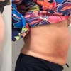 Image 3: Up to 60% Off on Cryolipolysis / Fat Freezing at Miso Life