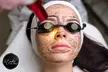 Laserowy peeling węglowy na twarz i szyję w Studio Wizażu i Stylizacji w Rzeszowie - Second Medium