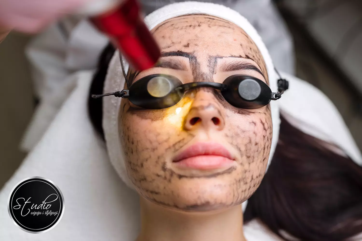 Laserowy peeling węglowy