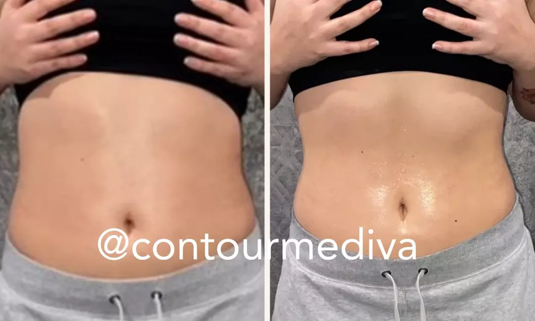 Up to 50% Off on Ultrasonic Fat Reduction at Contour me diva