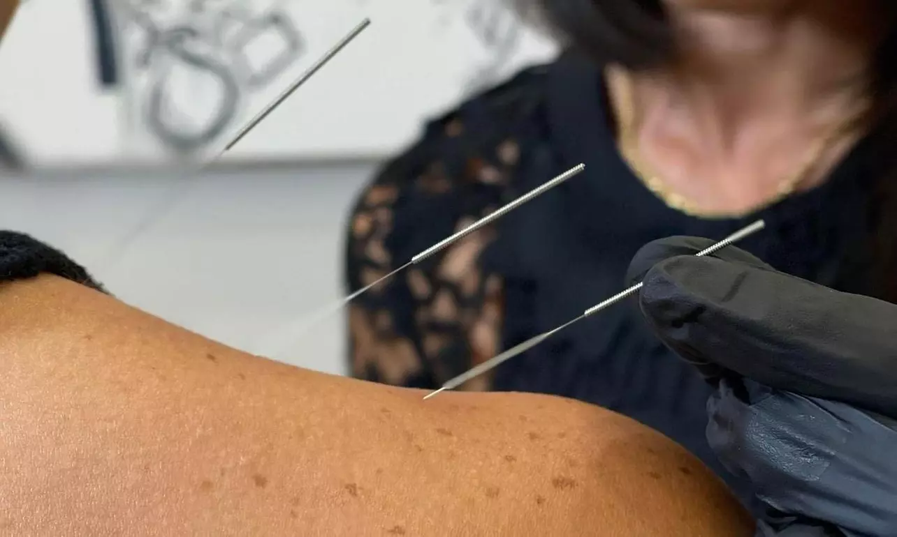 Explore Ishine Clinic's Acupuncture Options with Three or Five Sessions and save up to 50% - Second Medium