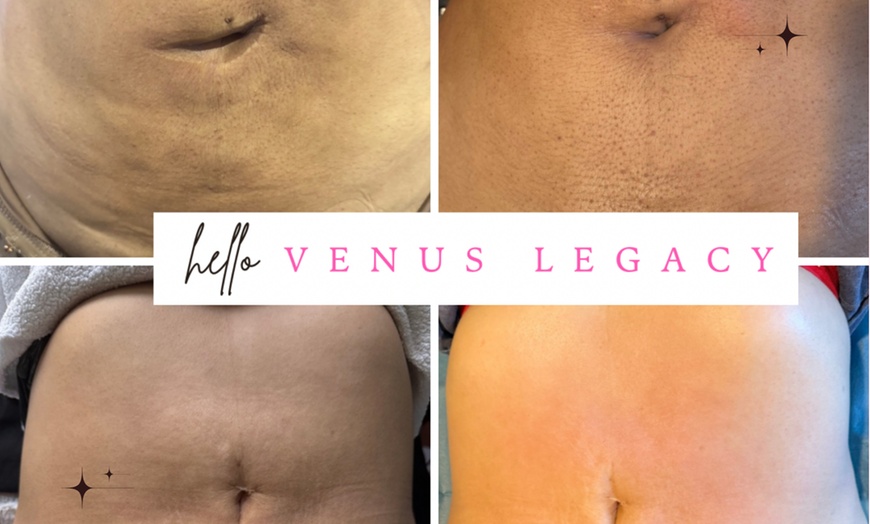 Image 2: Up to 50% Off on Lipo - Non-Invasive Laser-iLipo at Enchanted Curves @ Zenfultouch