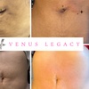 Image 2: Up to 40% Off on Lipo - Non-Invasive Laser-iLipo at Enchanted Curves @ Zenfultouch