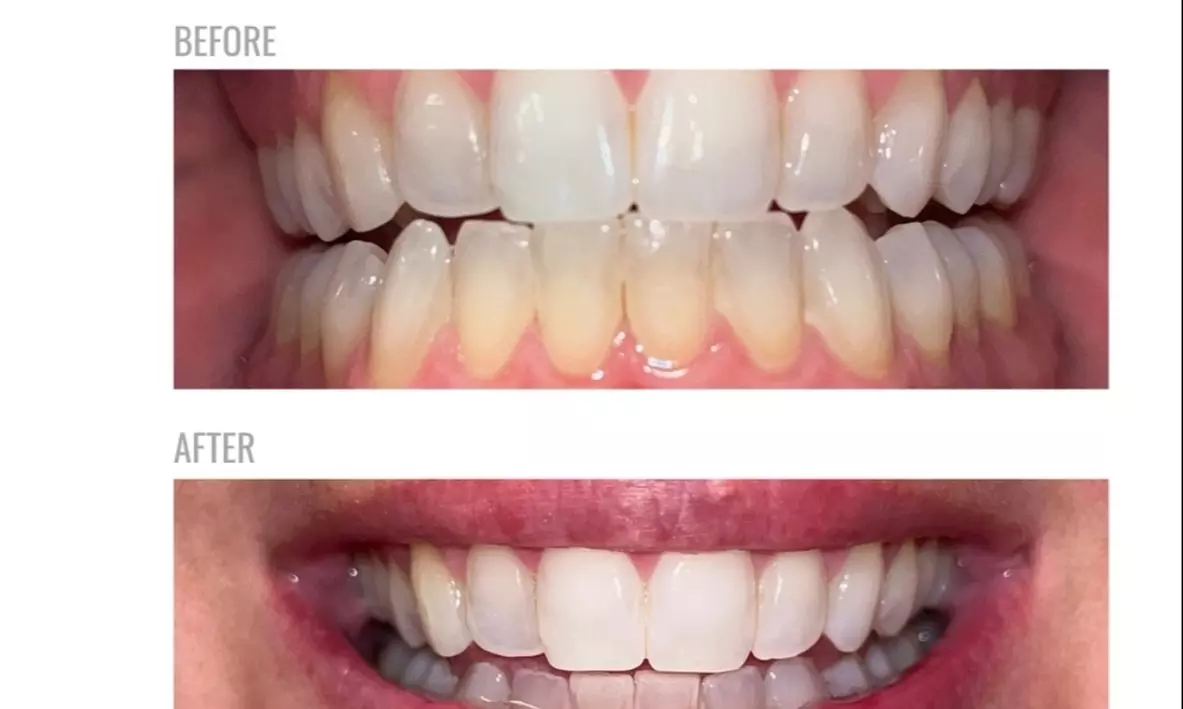 Up to 50% Off on Teeth Whitening - In-Office - Branded (Zoom, Brite Smile) at LASER BY K AESTHETICS - Primary Image