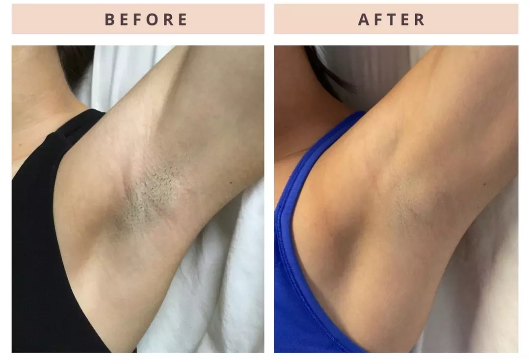 Get Smooth Skin with LHR service for Small, Medium and Large Areas