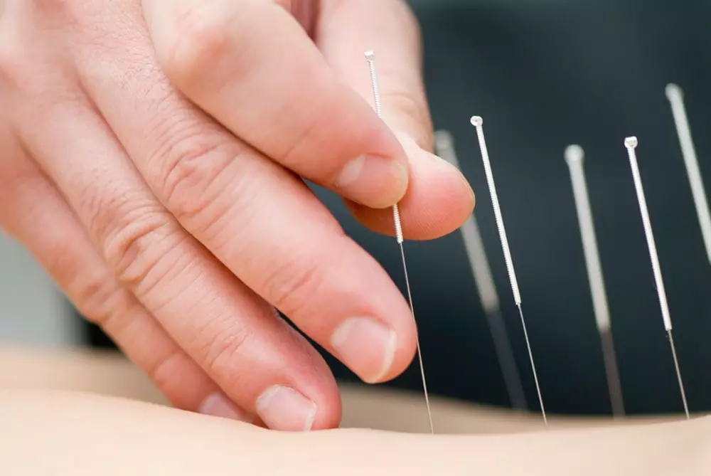 Up to 33% Off on Acupuncture at Nguyen Wellness & Recovery - Primary Image