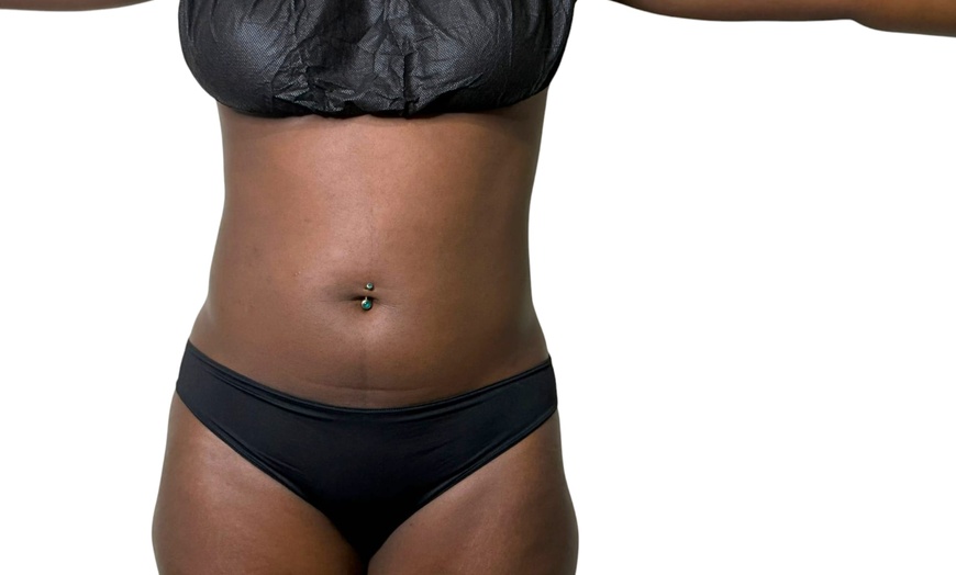 Image 2: One, Three or Six Ultrasound Cavitation Sessions or Wood Therapy