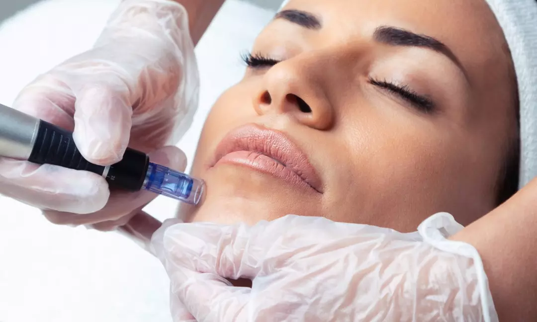 Up to 40% Off on Micro-Needling at UNIQUE STUDIO ROSS - Primary Image