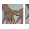 Image 2: Laser Skin Rejuvenation for Face, Neck, or Hands