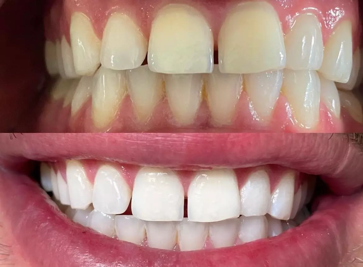Experience Emira's dental grade teeth whitening for a radiant smile, with up to 50% off! - Primary Image