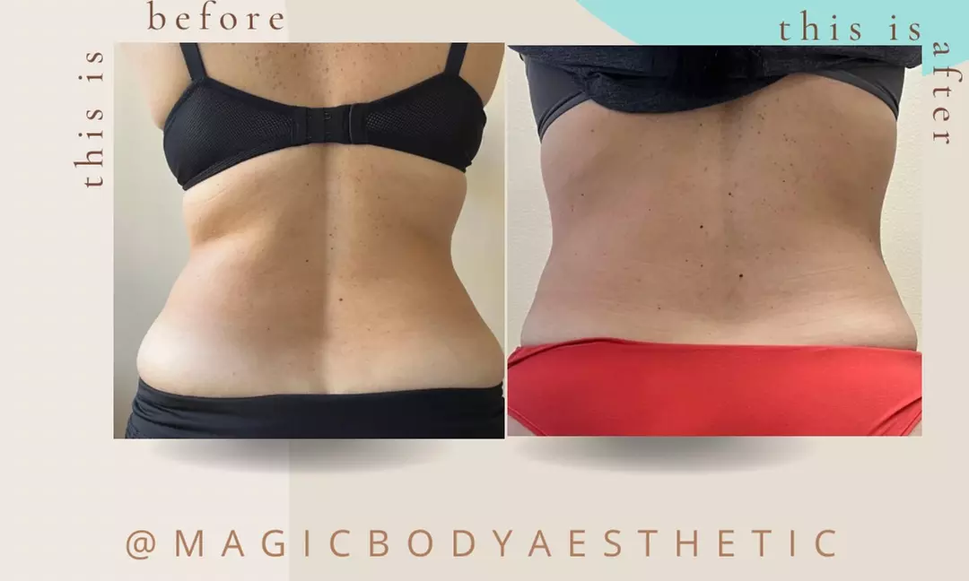 Up to 60% Off on Ultrasonic Fat Reduction at Magic Body Aesthetic