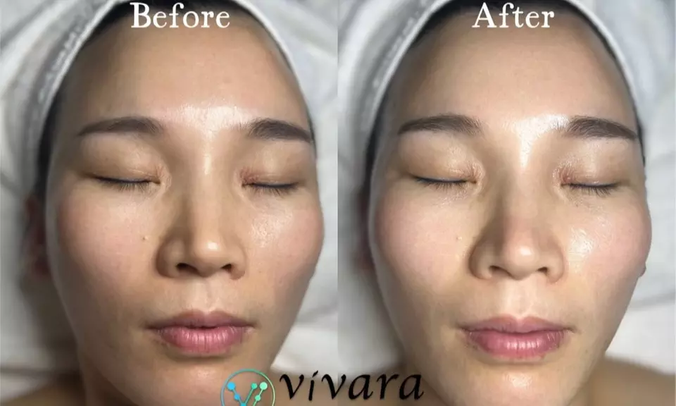 Dive into Radiance: Hydrating Facial or Organic Facial with LED Therapy & More at Vivara Med Spa - Up to 79% Off - Primary Image