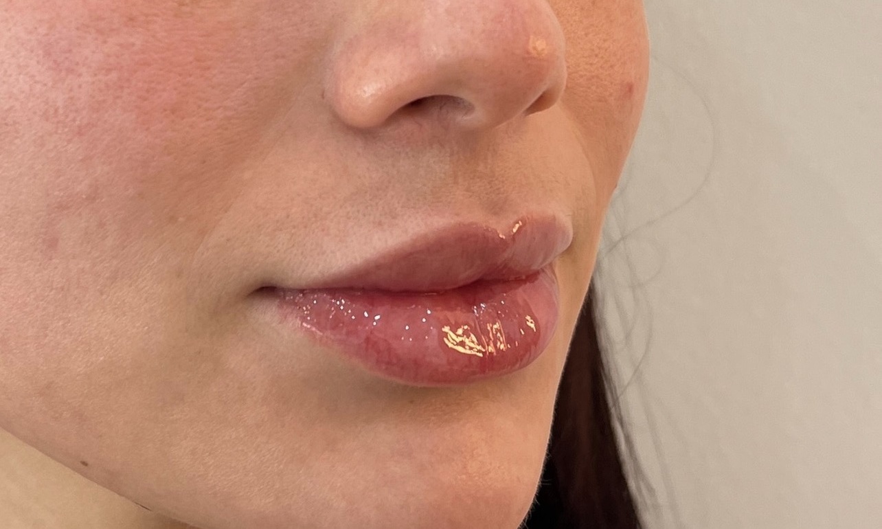 Pucker Up! Transform Your Smile with Irresistible Lip Enhancements!