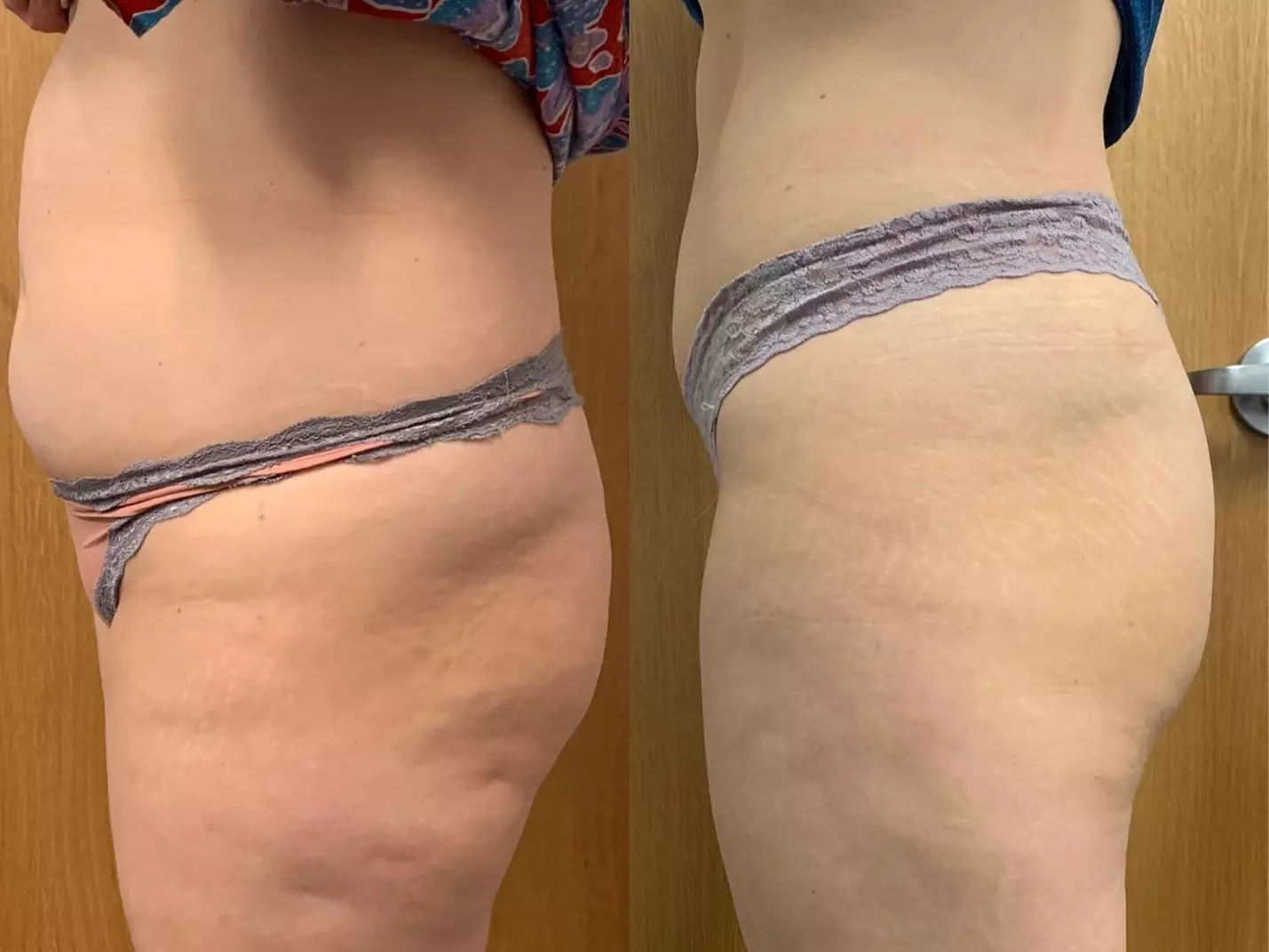 One session of Electromagnetic Sculpting for muscle toning