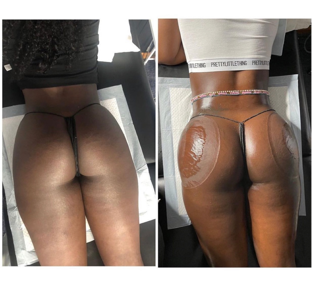 Non-surgical butt lift sessions with no pain or downtime